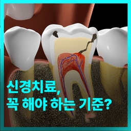 신경치료, 꼭 해야 하는 기준?의 썸네일