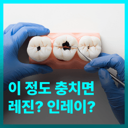 이 정도면 충치면 레진? 인레이?의 썸네일